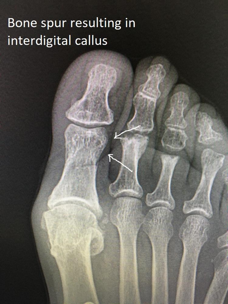 x-ray interdigital callus resection